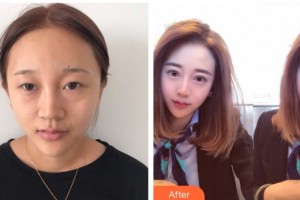 泰州愛爾眼科醫(yī)院王秋燕整形價格表附眼部綜合案例展示