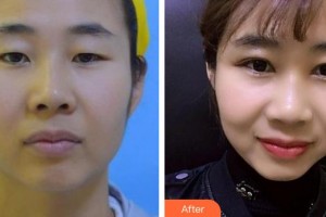 泰州愛爾眼科醫(yī)院胡正再整形價格表附切開雙眼皮案例展示