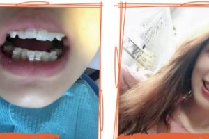 泰州北極星口腔門診部梁如雪整形價格表附牙貼面案例展示