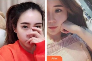 泰州玲瓏口腔門診部黃雨琴整形價格表附牙齒隱形矯正例展示