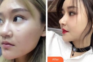 鎮(zhèn)江瑞麗醫(yī)療美容醫(yī)院端木雪峰整形價格表附鼻部綜合案例展示