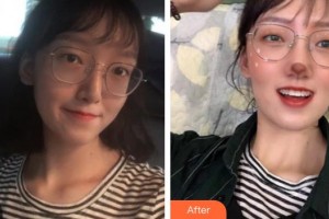 鎮(zhèn)江市口腔醫(yī)院朱鎮(zhèn)整形價(jià)格表附金屬托槽矯正案例展示