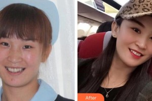 湘潭愛爾眼科醫(yī)院劉祥明整形價格表附眼部綜合案例展示