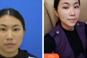 湘潭愛爾眼科醫(yī)院羅皓平整形價格表附定點(diǎn)雙眼皮案例展示