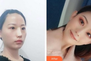 永州博美整形美容醫(yī)院陳建華住院醫(yī)師整形價格表附鼻部綜合案例展示