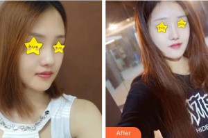 永州新唯美整形美容醫(yī)院王勇整形價格表附鼻部綜合案例展示