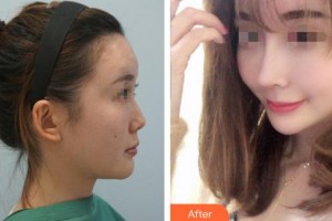永州新唯美整形美容醫(yī)院李琴整形價格表附肋軟骨隆鼻案例展示