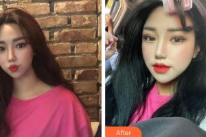 永州美辰整形美容醫(yī)院劉志高整形價格表附鼻部綜合案例展示