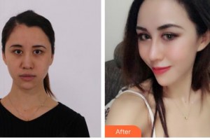 永州美辰整形美容醫(yī)院唐航整形價格表附鼻部綜合案例展示