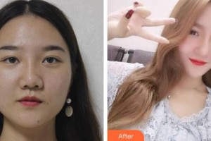 永州傾城醫(yī)療美容門診部嚴(yán)興萍整形價格表附假體隆鼻案例展示