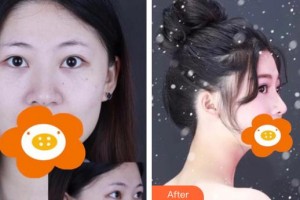 永州傾城醫(yī)療美容門診部楊維整形價格表附鼻部綜合案例展示