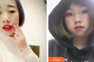 永州中南口腔醫(yī)院唐純玉整形價格表附根管調(diào)節(jié)案例展示