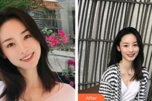 永州中南口腔醫(yī)院邵碩整形價格表附金屬托槽矯正案例展示