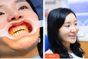 永州牙博士口腔醫(yī)院陳東波整形價格表附美白貼片案例展示