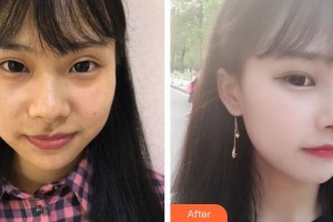 永州愛(ài)爾眼科醫(yī)院唐勛倫整形價(jià)格表附埋線雙眼皮案例展示