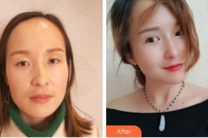 永州愛(ài)爾眼科醫(yī)院李格明整形價(jià)格表附眼部綜合案例展示