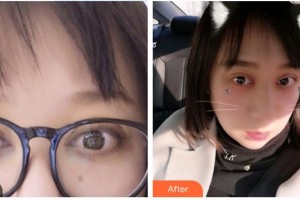 永州愛(ài)爾眼科醫(yī)院胡艷玲整形價(jià)格表附外切祛眼袋案例展示