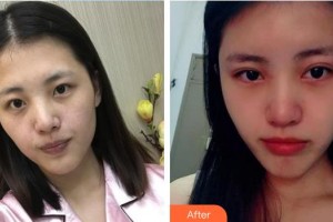 永州愛(ài)爾眼科醫(yī)院李玉婷整形價(jià)格表附切開(kāi)雙眼皮案例展示