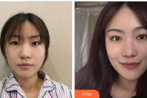 永州市第一人民醫(yī)院眼科趙永旺整形價(jià)格表附切開(kāi)雙眼皮案例展示