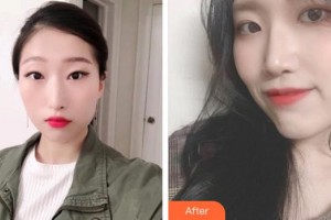 永州愛(ài)爾眼科醫(yī)院陳艷文整形價(jià)格表附眼部綜合案例展示