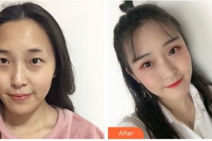 順德愛爾眼科醫(yī)院劉巧萍整形價格表附眼部綜合案例展示