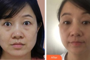 順德愛爾眼科醫(yī)院趙亞軍整形價格表附切開雙眼皮案例展示