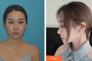 順德愛爾眼科醫(yī)院梁先軍整形價格表附切開雙眼皮案例展示