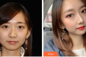 漢中卓美整形外科門診部李國(guó)棟整形價(jià)格表附熱瑪吉案例展示