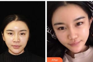 漢中韓美整形美容醫(yī)院常雙模整形價(jià)格表附埋線提升案例展示