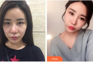 漢中南方醫(yī)療美容診所李雪整形價(jià)格表附埋線提升案例展示