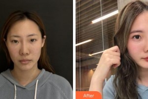 漢中天漢伊美醫(yī)療美容門診部張茜整形價(jià)格表附熱瑪吉案例展示