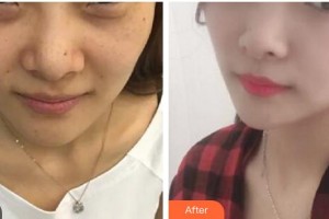 漢中天漢伊美醫(yī)療美容門診部潘會(huì)章整形價(jià)格表附埋線提升案例展示