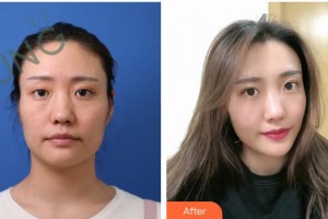 漢中祥瑞海天醫(yī)療美容診所馬嫣旎整形價(jià)格表附埋線提升案例展示