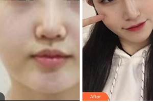 漢中祥瑞海天醫(yī)療美容診所高玉慶整形價(jià)格表附埋線提升案例展示