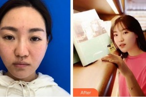 漢中職業(yè)技術(shù)學(xué)院附屬醫(yī)院眼科方彤整形價(jià)格表附埋線提升案例展示