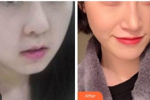 漢中天漢伊美醫(yī)療美容門診部王伶霄整形價(jià)格表附埋線提升案例展示