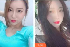 榆林婦產(chǎn)?？漆t(yī)院韓式整形美容中心宋寶強(qiáng)整形價(jià)格表附切開雙眼皮案例展示