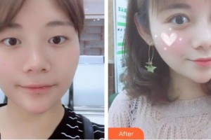 榆林愛爾眼科醫(yī)院高利梅整形價(jià)格表附切開雙眼皮案例展示