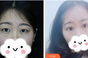 榆林市中醫(yī)醫(yī)院眼科醫(yī)院李武軍整形價(jià)格表附切開雙眼皮案例展示