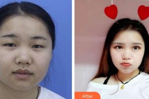 榆林市中醫(yī)醫(yī)院眼科醫(yī)院李建秀整形價(jià)格表附切開雙眼皮案例展示