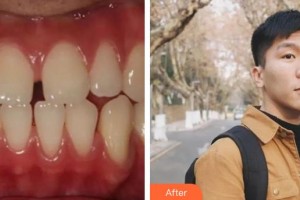 榆林市第四醫(yī)院口腔科侯小峰整形價(jià)格表附金屬托槽矯正案例展示