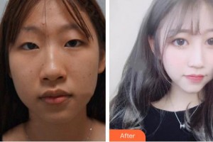 榆林市中醫(yī)醫(yī)院眼科醫(yī)院鄭樹鋒整形價(jià)格表附定點(diǎn)雙眼皮案例展示