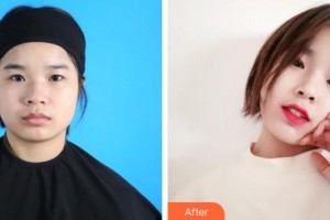 榆林愛爾眼科醫(yī)院蘇榆生整形價(jià)格表附眼部綜合案例展示