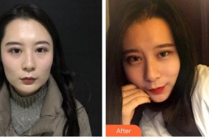 武安安康醫(yī)院整形美容中心李連貴整形價(jià)格表附埋線提升案例展示