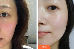 安康蝶姿醫(yī)療美容門診部慎公關(guān)整形價(jià)格表附美白導(dǎo)入案例展示