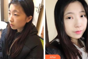 安康愛爾眼科醫(yī)院方學(xué)軍整形價(jià)格表附開內(nèi)眼角案例展示