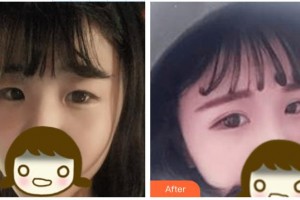 安康愛爾眼科醫(yī)院周進(jìn)整形價(jià)格表附切開雙眼皮案例展示