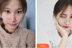 安康愛爾眼科醫(yī)院李紹偉整形價(jià)格表附眼部綜合案例展示