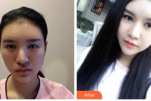 安康愛爾眼科醫(yī)院龔力力整形價(jià)格表附眼部綜合案例展示