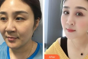 安康希顏醫(yī)療美容診所高小峰整形價(jià)格表附眼部綜合案例展示